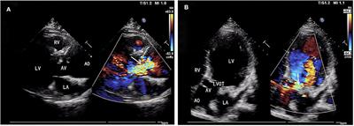 The Surgical Strategy for Progressive Dilatation of Aortic Root and Aortic Regurgitation After Repaired Tetralogy of Fallot: A Case Report